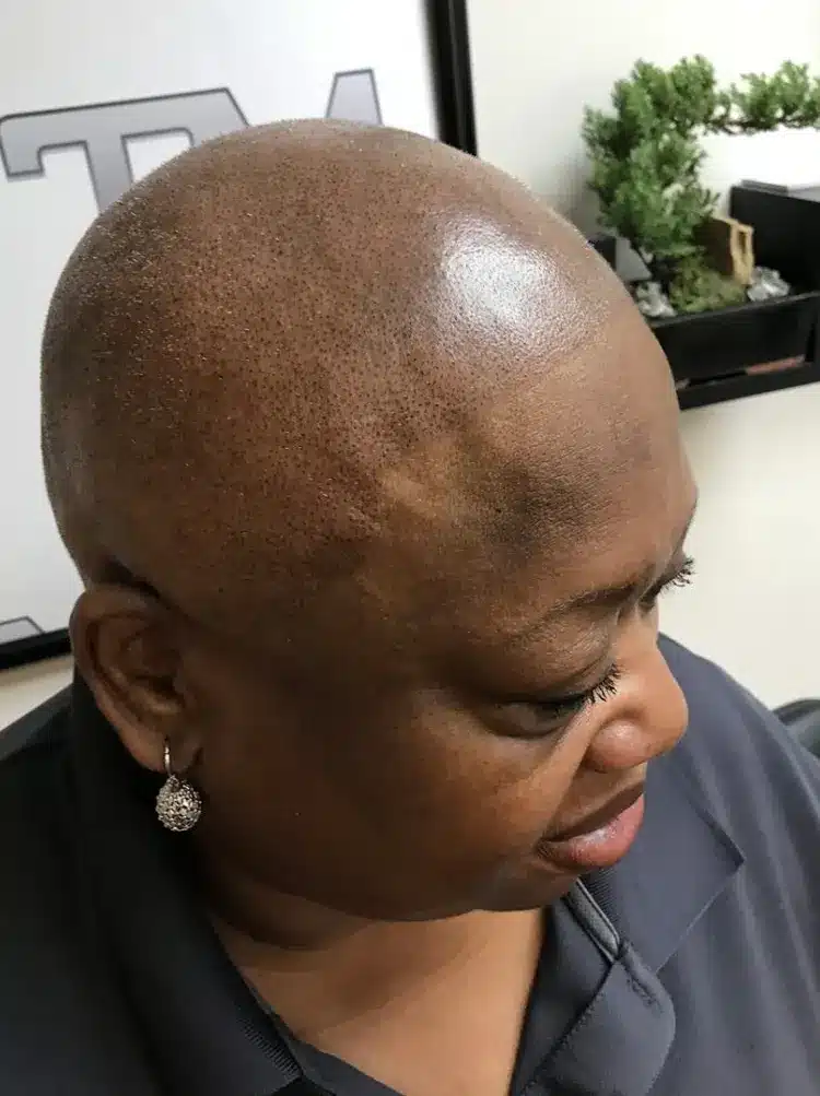 woman-after-scalp-micropigmentation