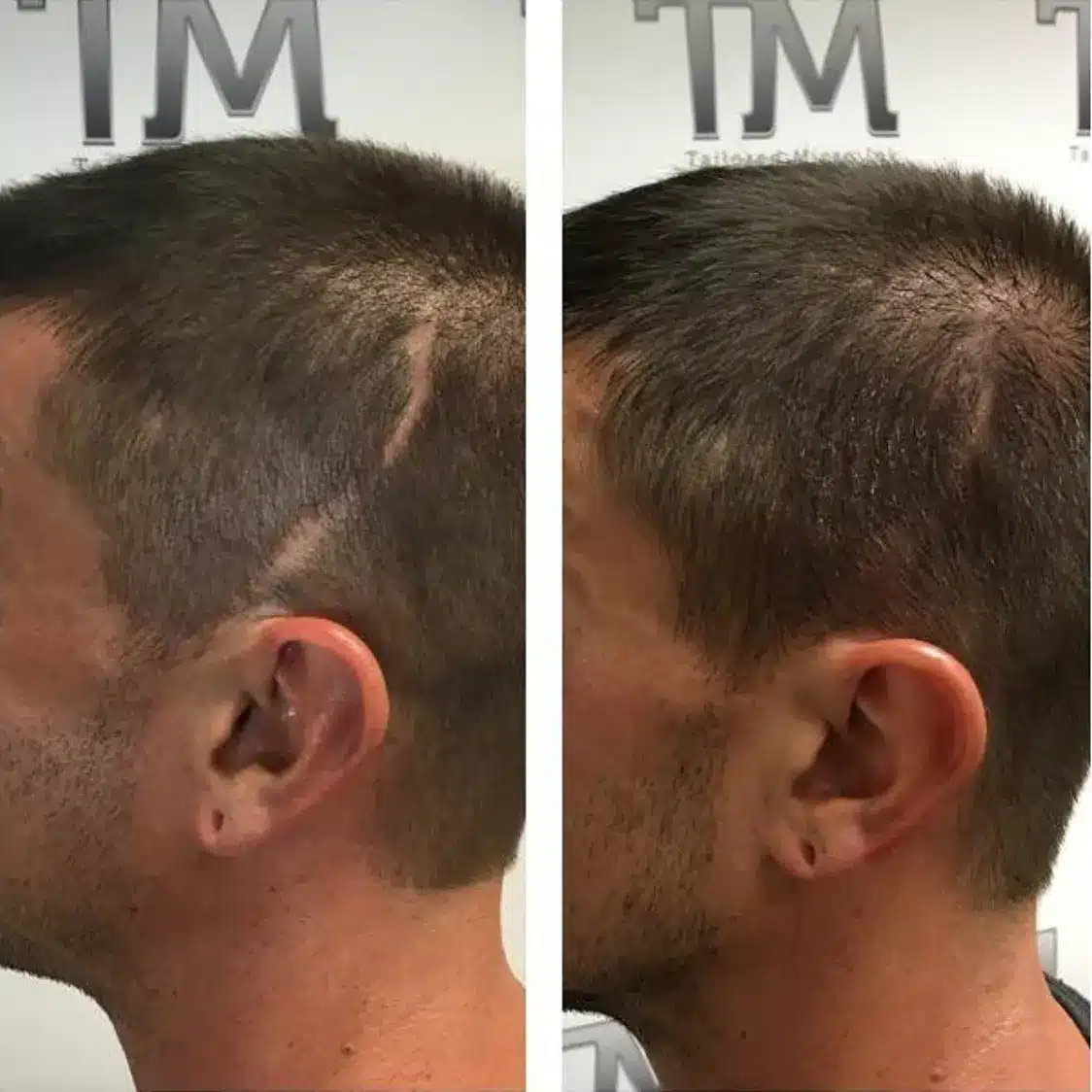 Read more about the article Scalp Micropigmentation For Scars